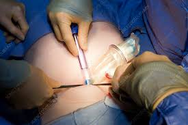 Inguinal Hernia Surgery: Mesh Options and Pricing in Mohali